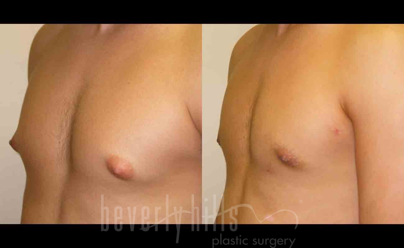 Gynecomastia patient 09 Before & After