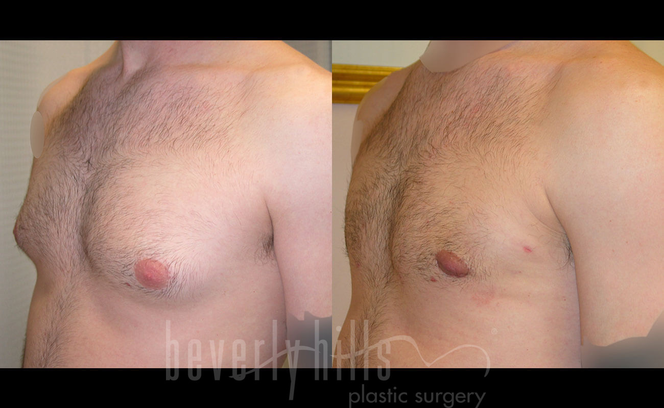 Gynecomastia Patient 14 Before & After