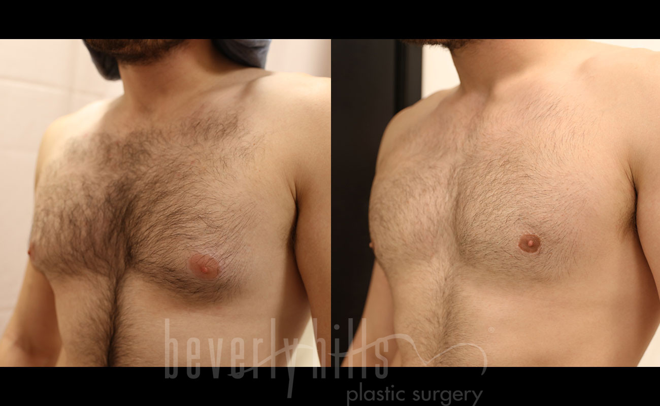 Gynecomastia Patient 11 Before & After