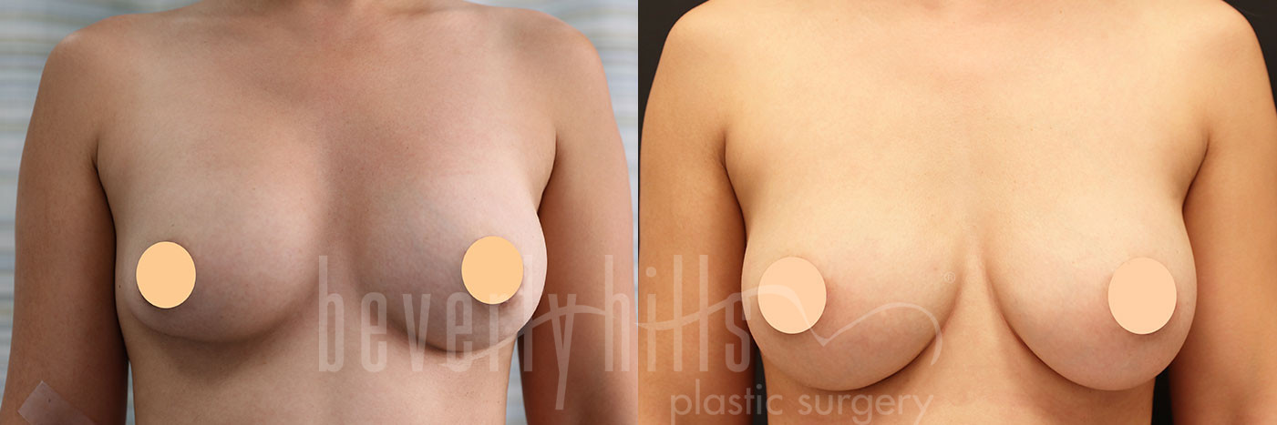 Breast Implant Exchange Patient 02 Before & After