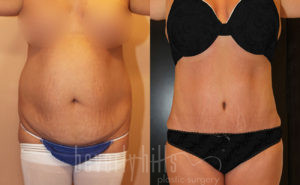 Tummy Tuck Patient 24 Before & After - Thumbnail