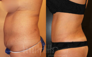 Tummy Tuck Patient 24 Before & After - Thumbnail