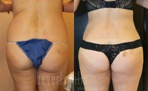 Liposuction Patient 01 Before & After - Thumbnail