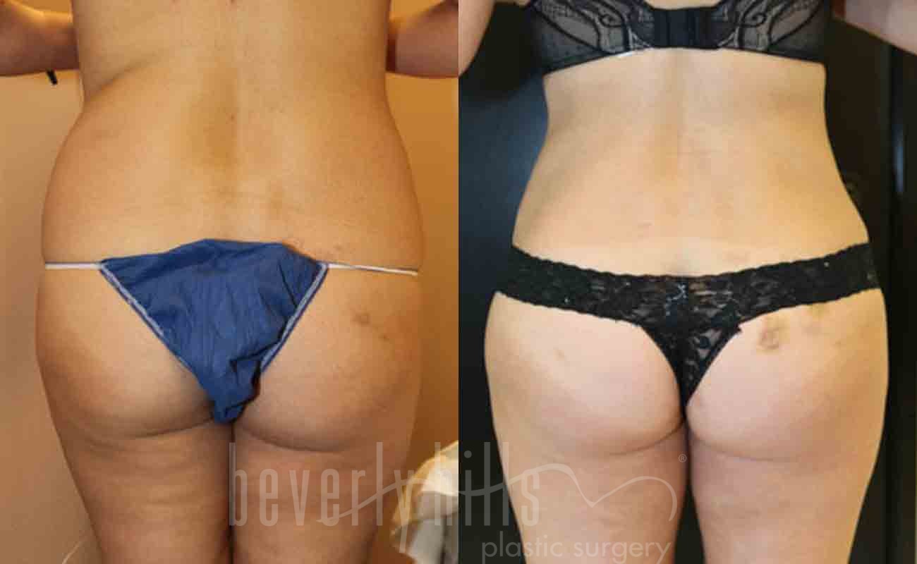 Liposuction Patient 01 Before & After