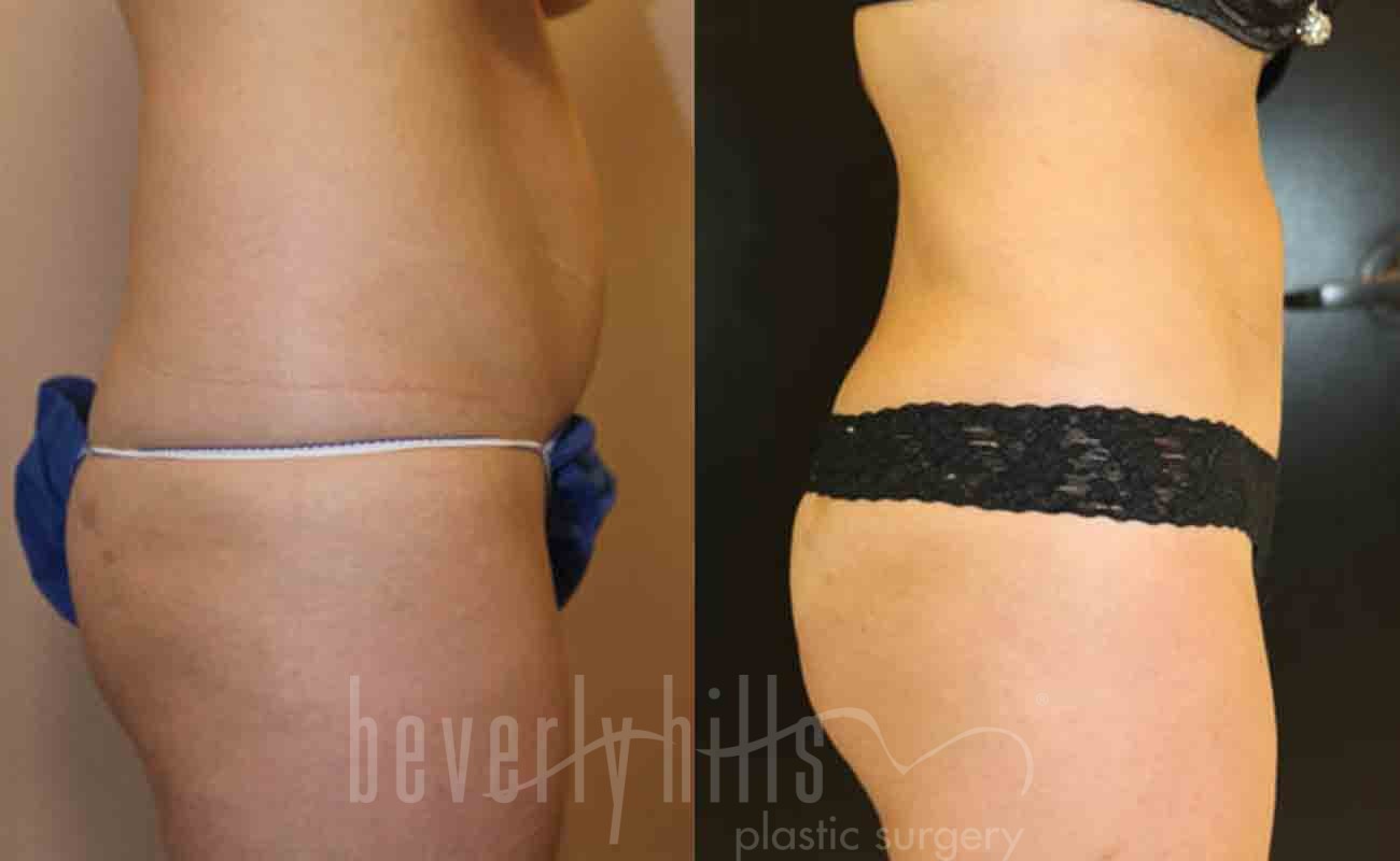 Liposuction Patient 01 Before & After