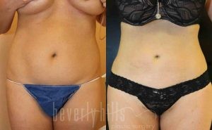 Liposuction Patient 01 Before & After - Thumbnail