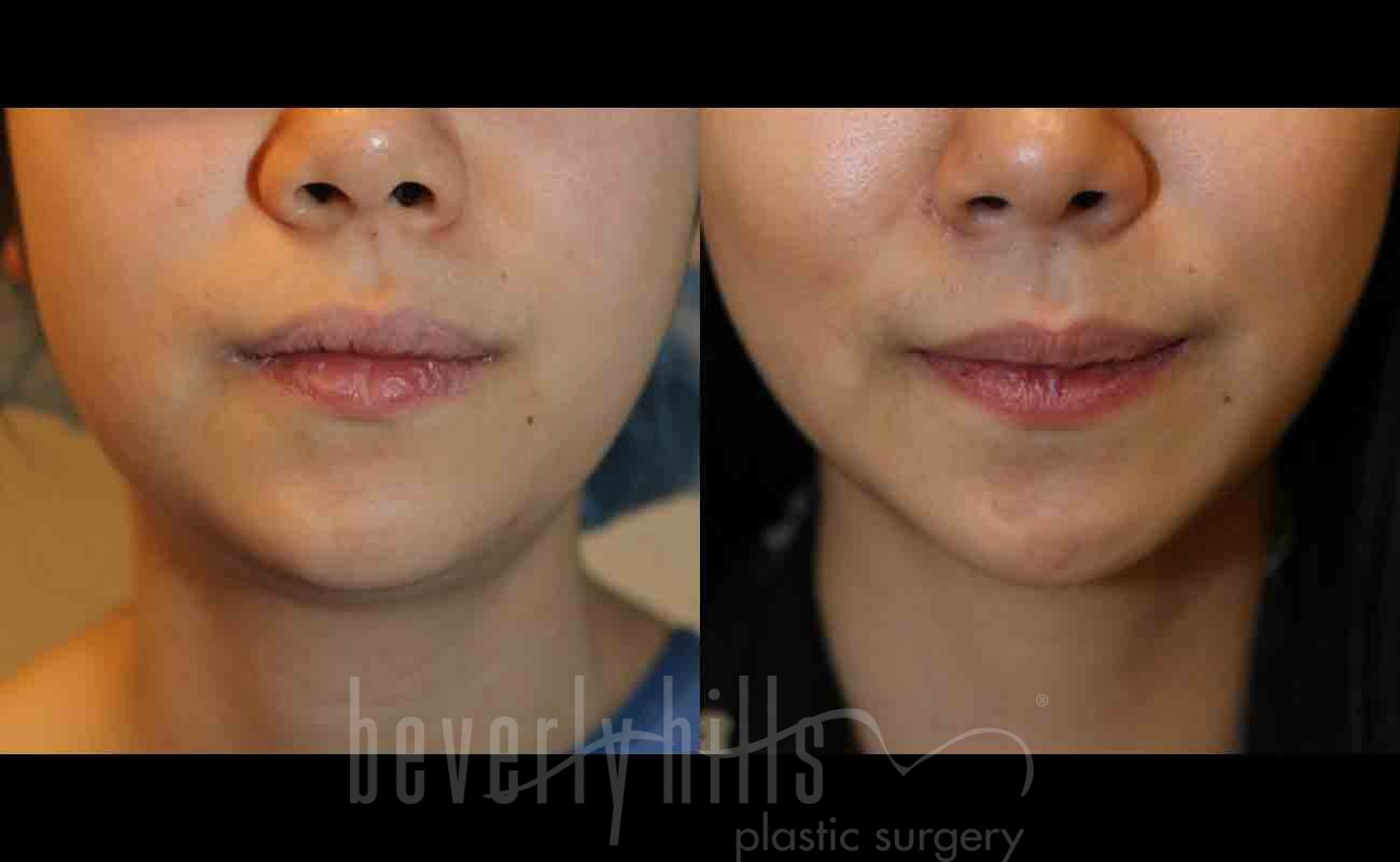 Liposuction Patient 02 Before & After