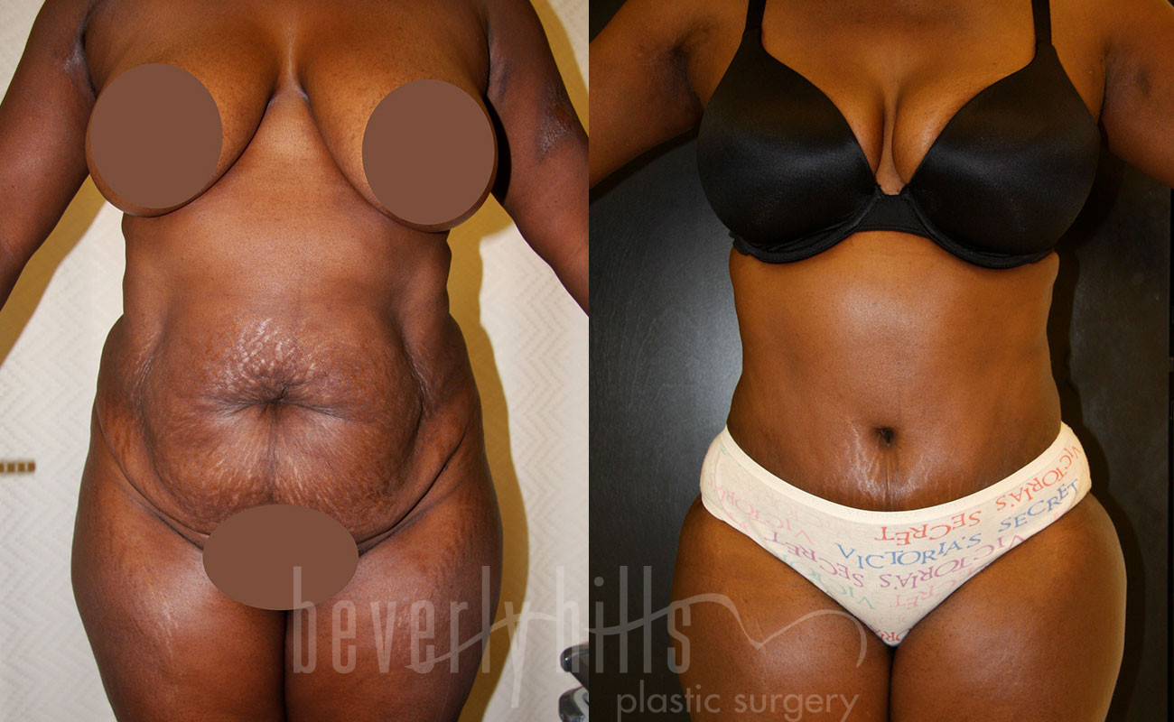 Tummy Tuck Patient 22 Before & After