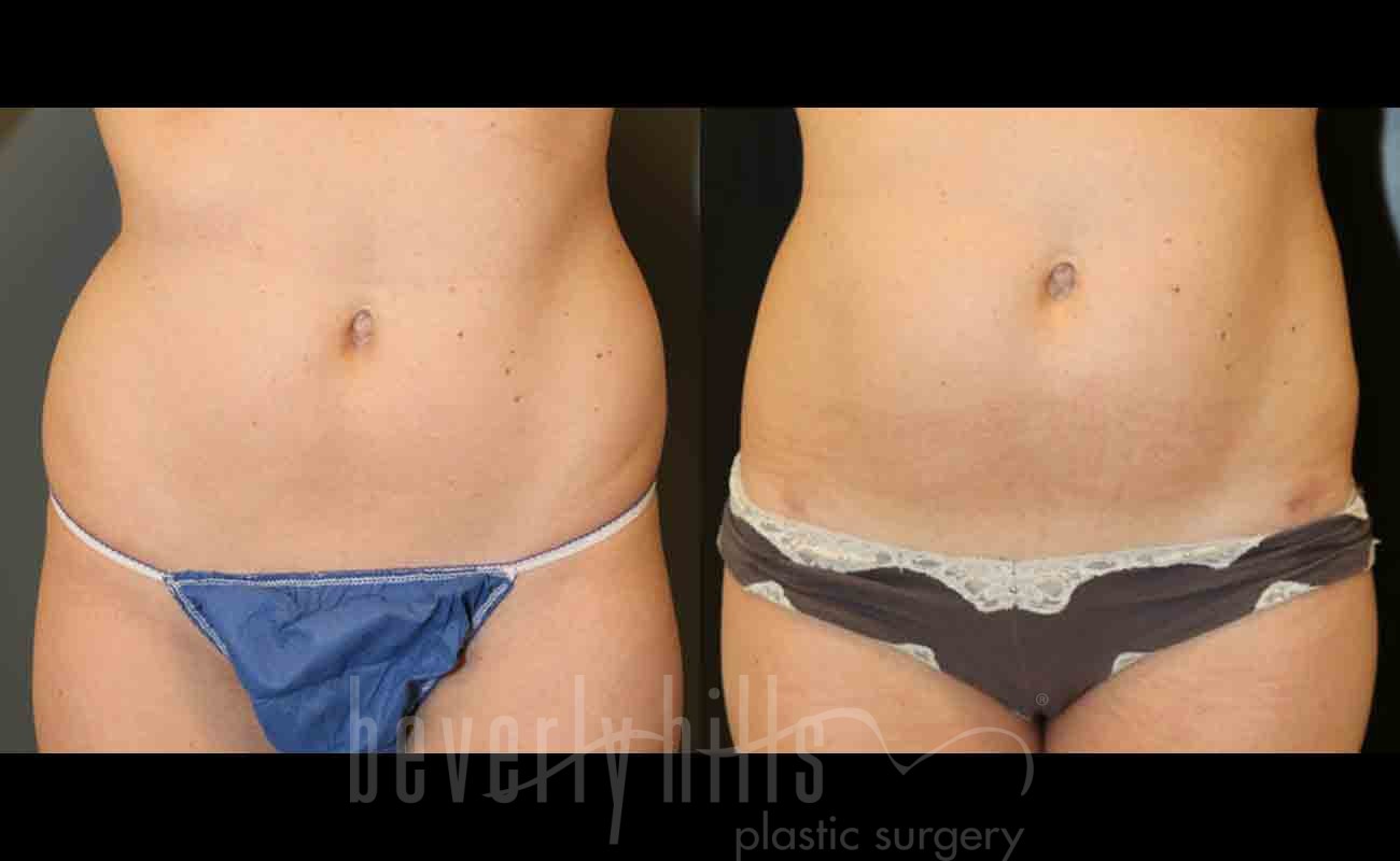 Liposuction Patient 03 Before & After