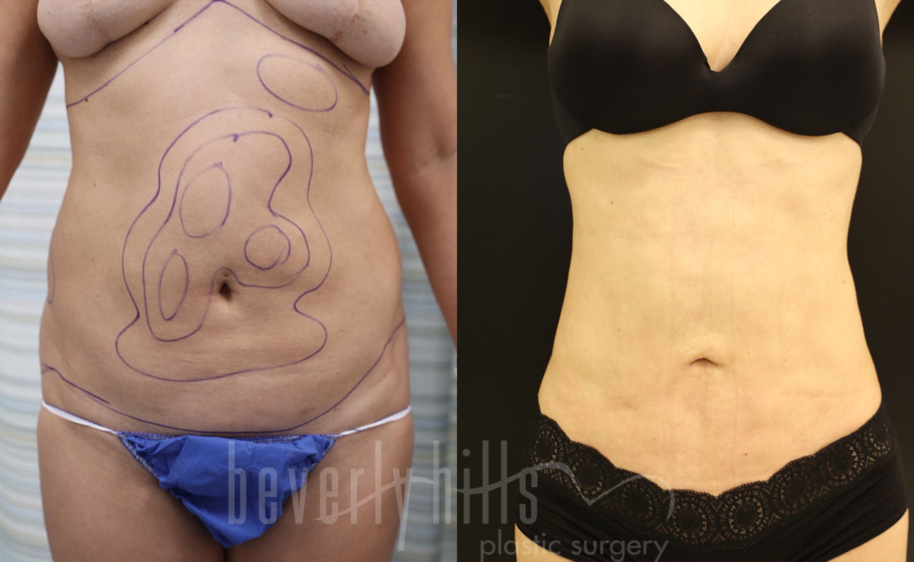 Liposuction Patient 39 Before & After