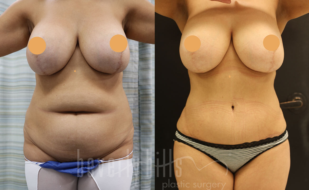 Tummy Tuck Patient 21 Before & After