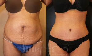 Tummy Tuck Patient 25 Before & After - Thumbnail