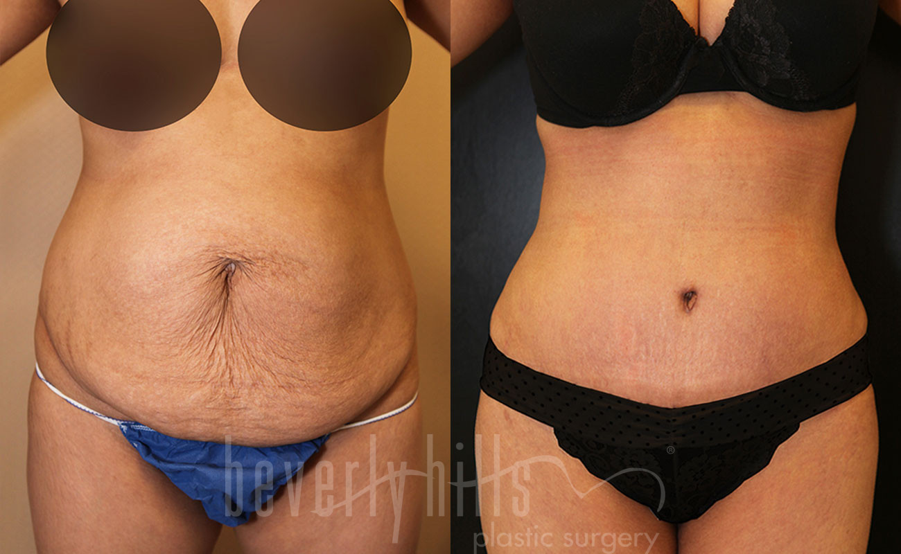 Tummy Tuck Patient 25 Before & After