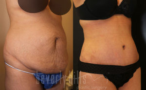 Tummy Tuck Patient 25 Before & After - Thumbnail