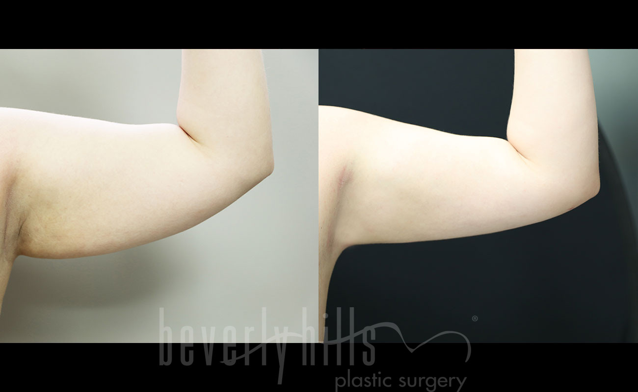 Liposuction Patient 52 Before & After