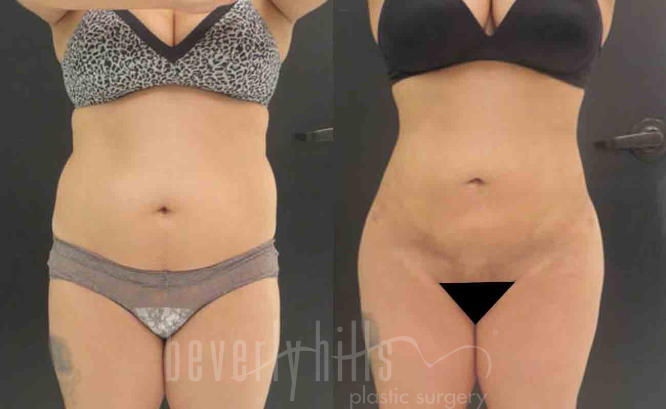 Liposuction Patient 04 Before & After