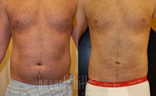 LIPOSUCTION PATIENT 44 Before & After