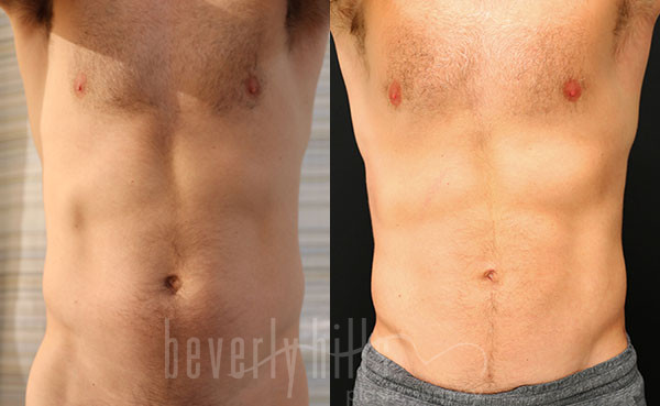 Liposuction Patient 54 Before & After