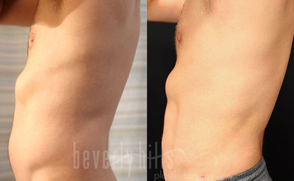 Liposuction Patient 54 Before & After