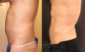 Liposuction Patent 51 Before & After - Thumbnail