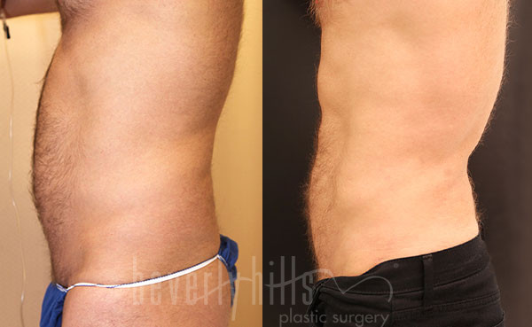 Liposuction Patent 51 Before & After