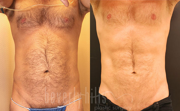 Liposuction Patent 51 Before & After