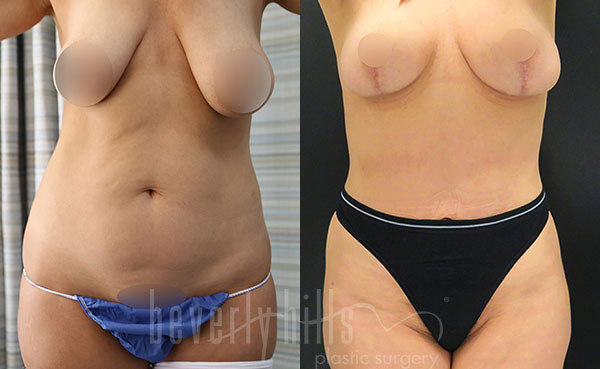 Liposuction Patient 55 Before & After