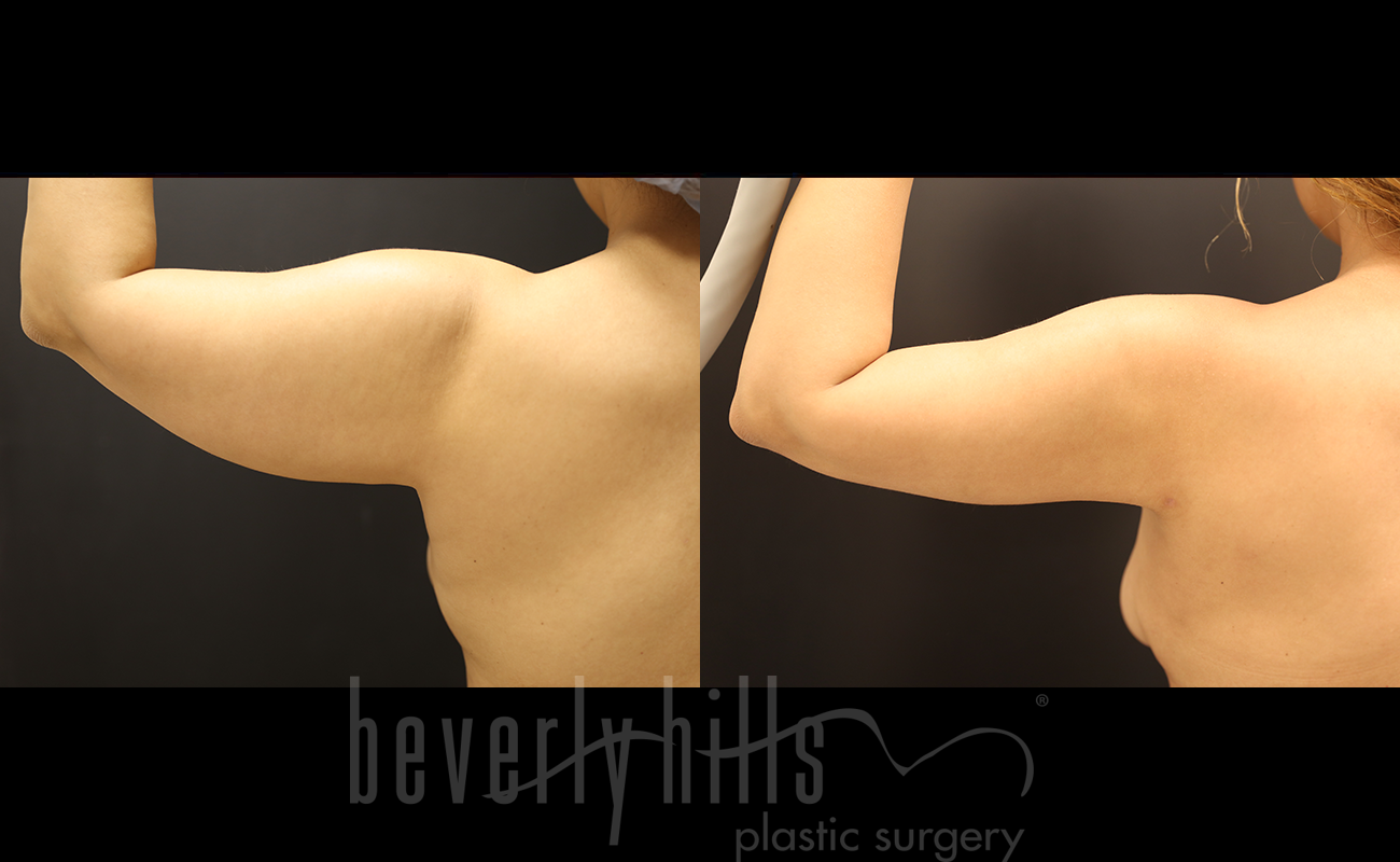 Liposuction Patient 49 Before & After