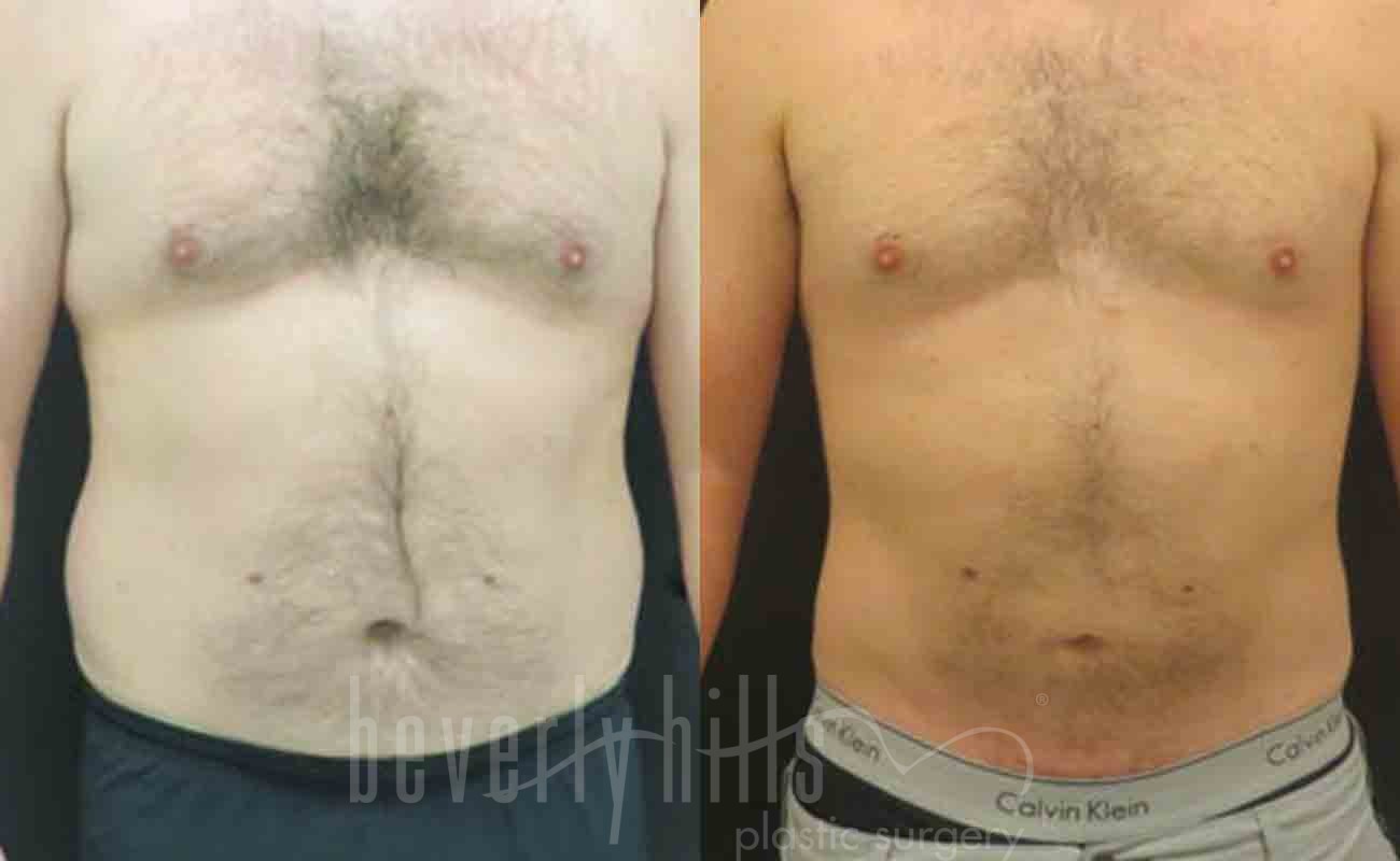 Abdominal Etching/Male Liposuction Patient 05 Before & After