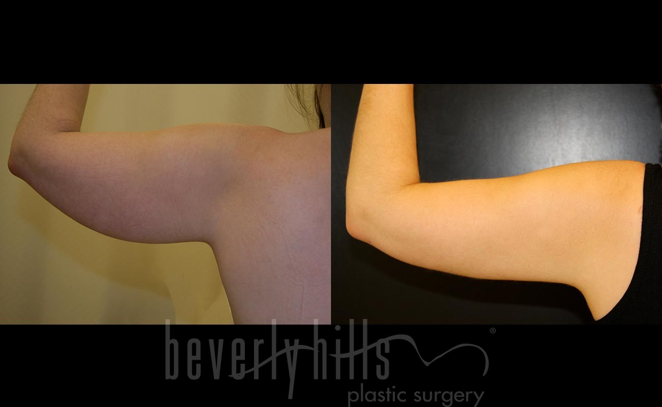 Liposuction Patent 50 Before & After