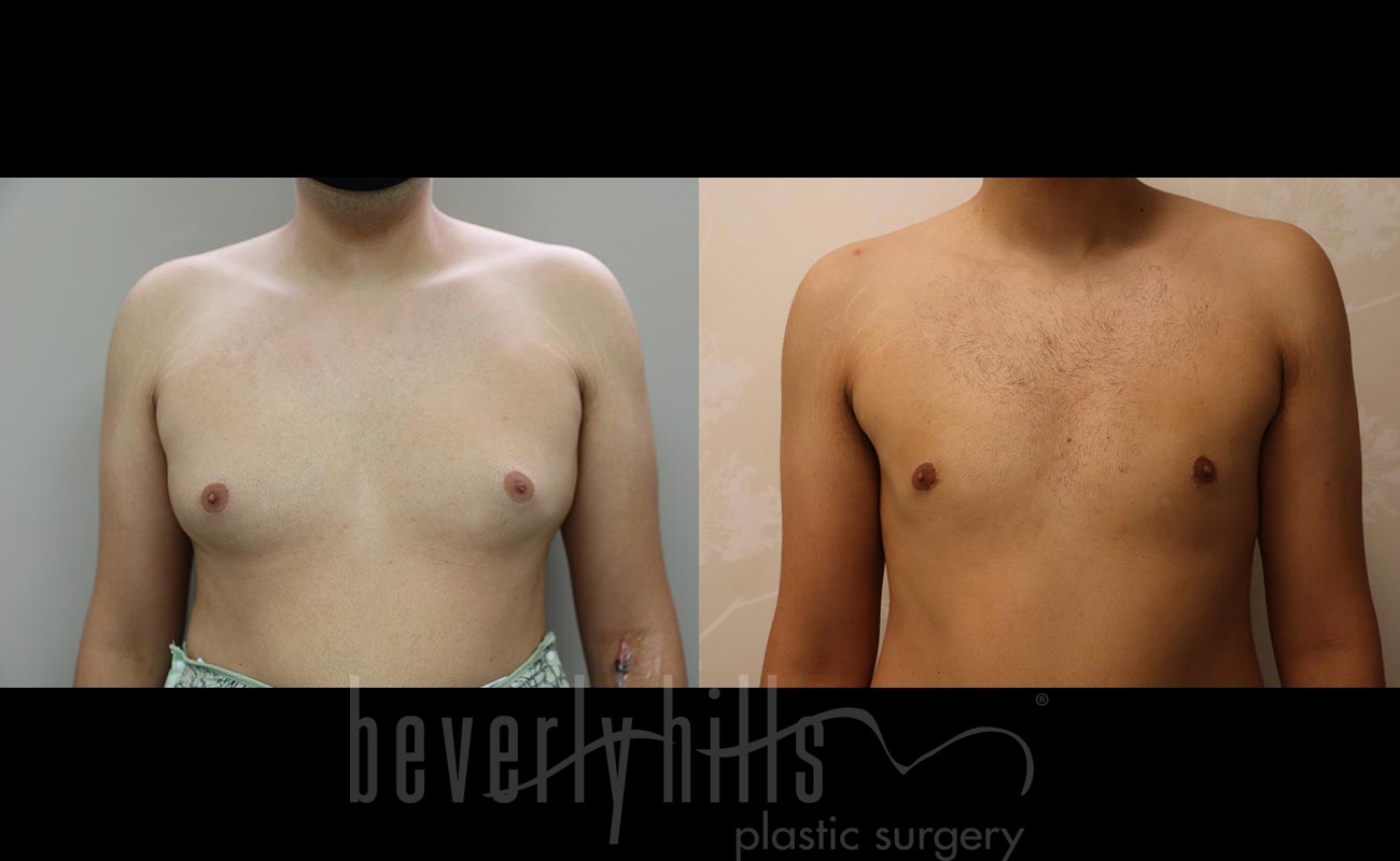 Liposuction Patient 51 Before & After