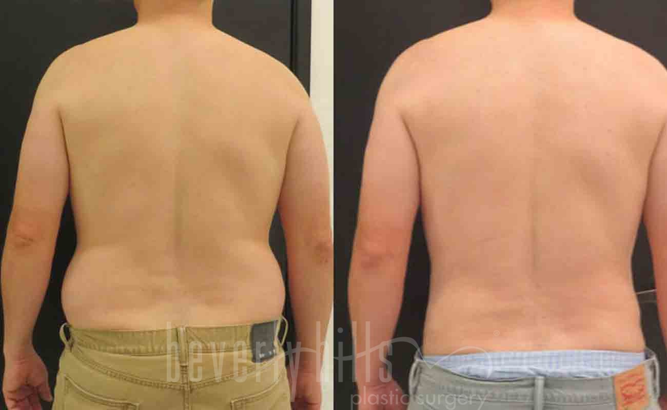 Abdominal Etching/Male Liposuction Patient 06 Before & After