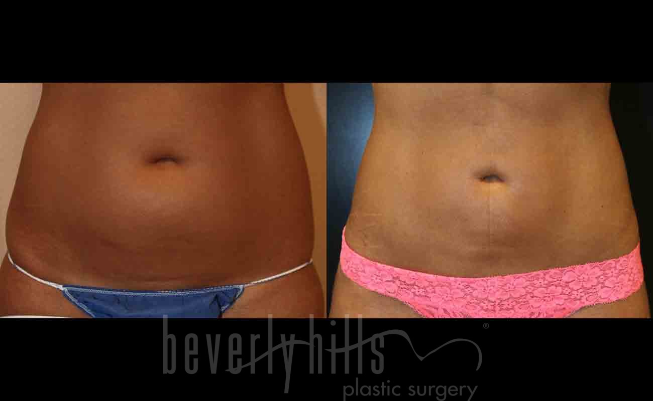Liposuction Patient 07 Before & After