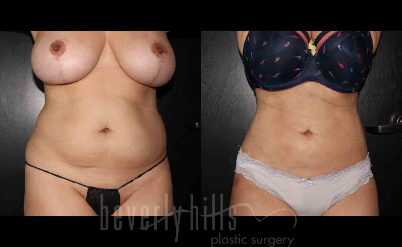 Liposuction Patient 08 Before & After