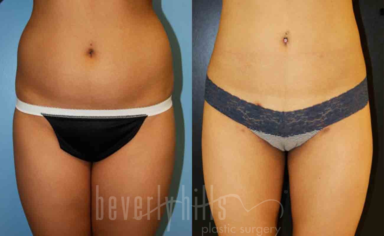 Tummy Tuck Patient  09 Before & After