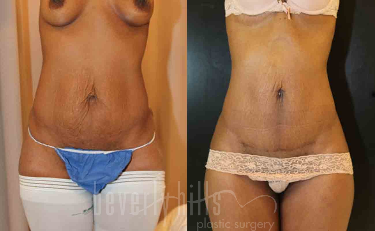 Liposuction Patient 09 Before & After