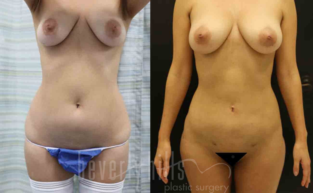 Liposuction Patient 10 Before & After