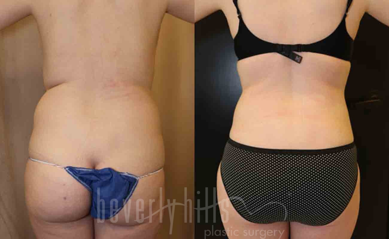 Liposuction Patient 11 Before & After