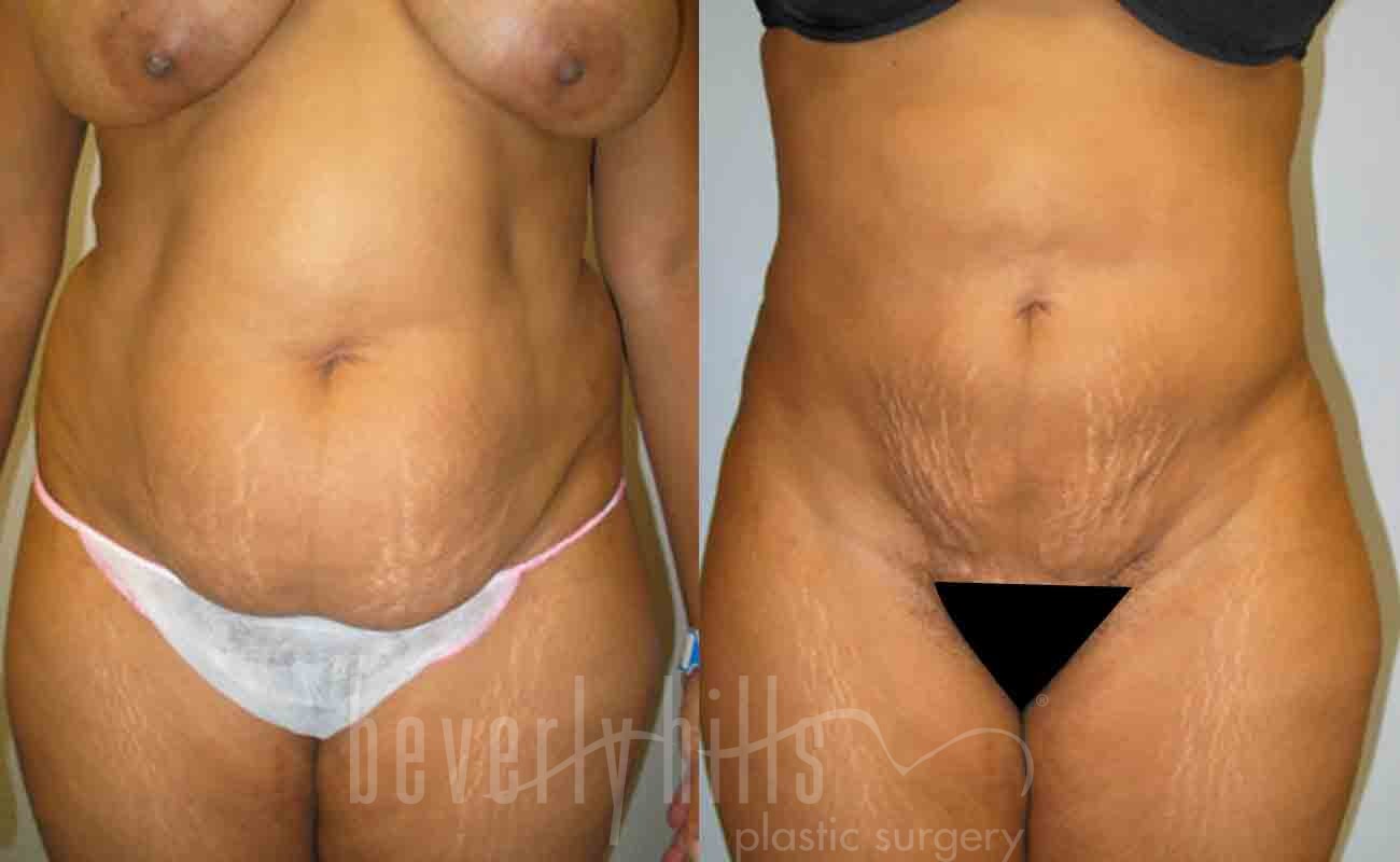 Liposuction Patient 12 Before & After
