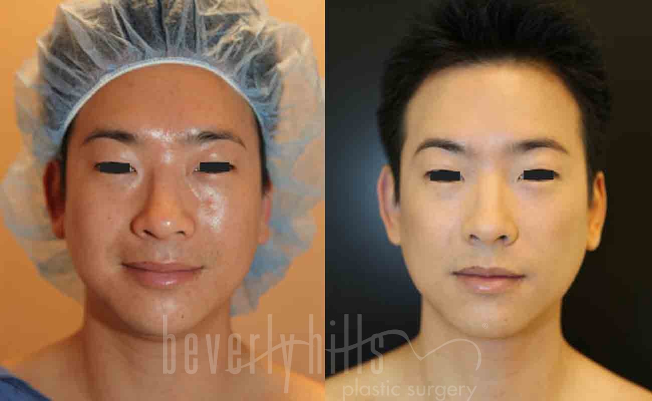 Rhinoplasty Patient 46 Before & After