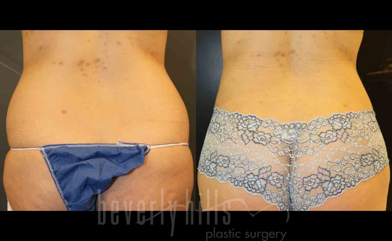 Liposuction Patient 14 Before & After