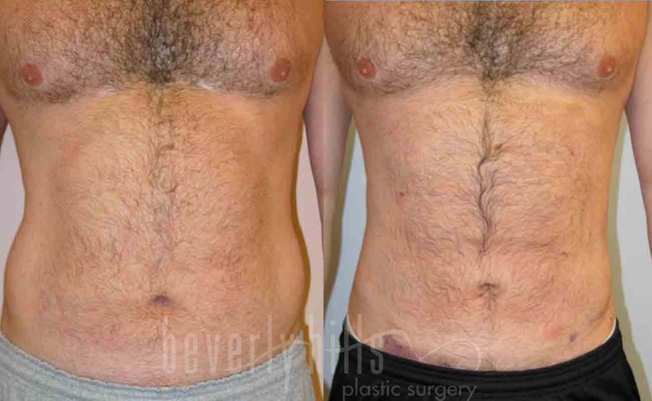Abdominal Etching/Male Liposuction Patient 09 Before & After