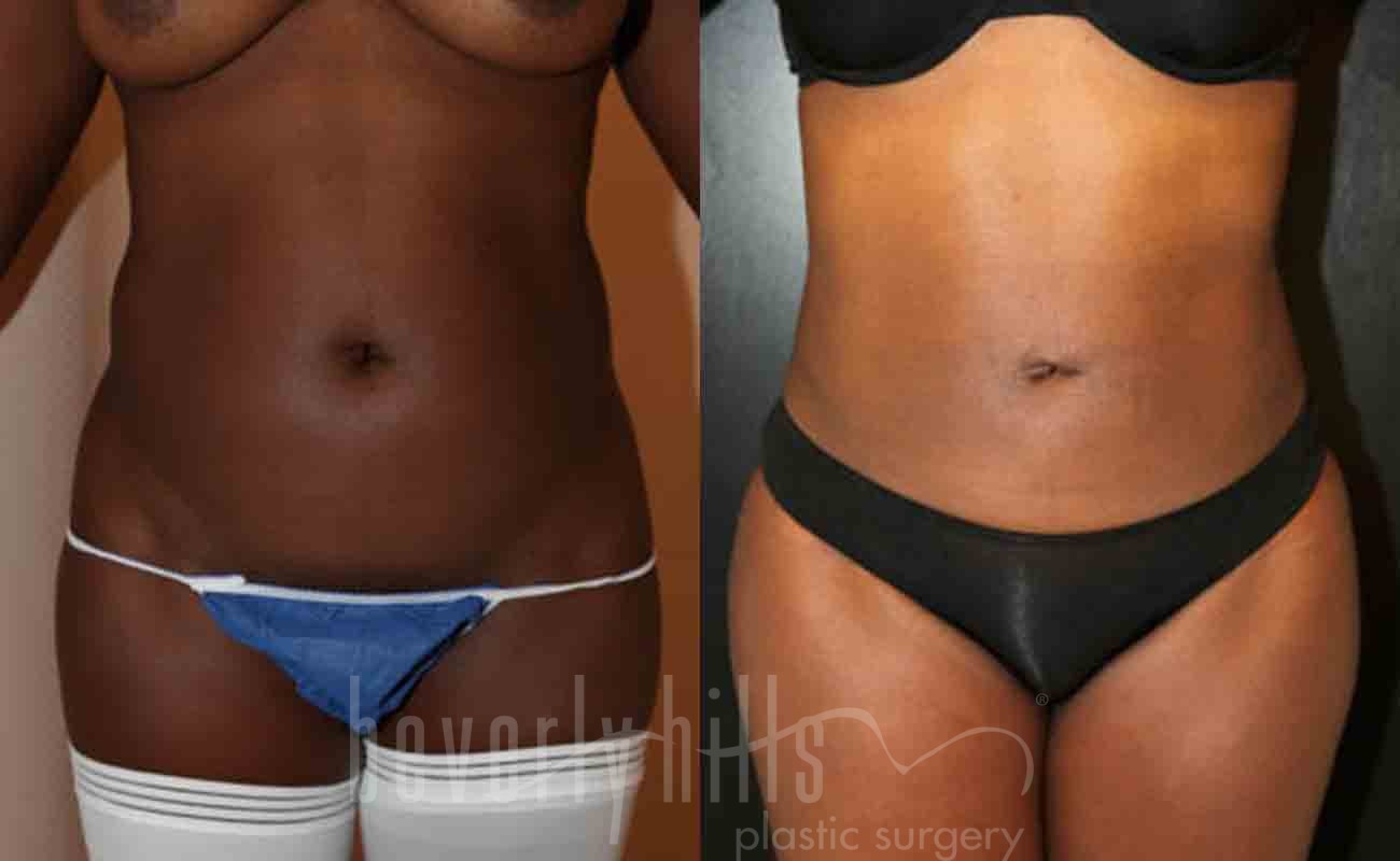 Liposuction Patient 16 Before & After