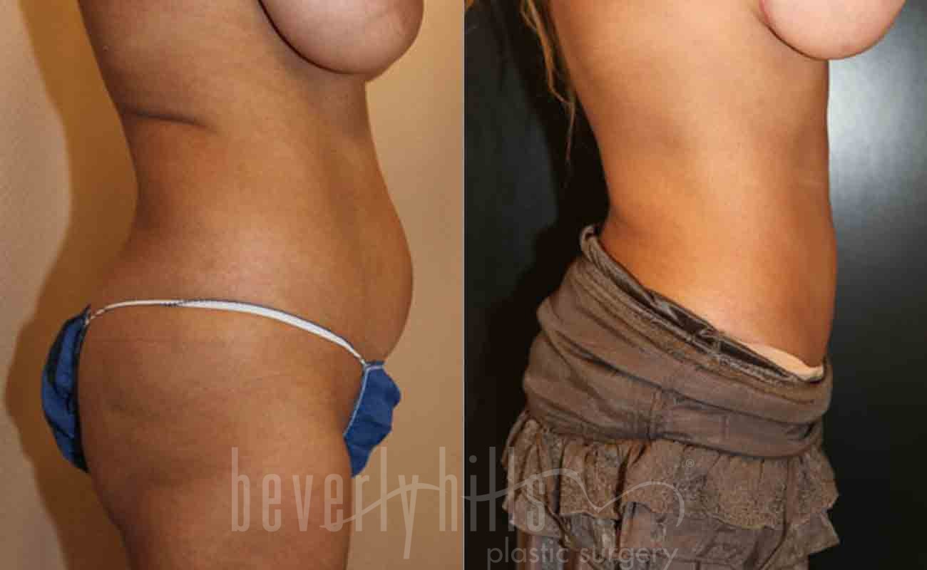 Liposuction Patient 17 Before & After