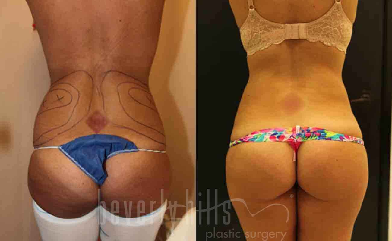 Liposuction Patient 18 Before & After