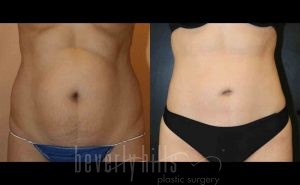 Liposuction Patient 20 Before & After - Thumbnail