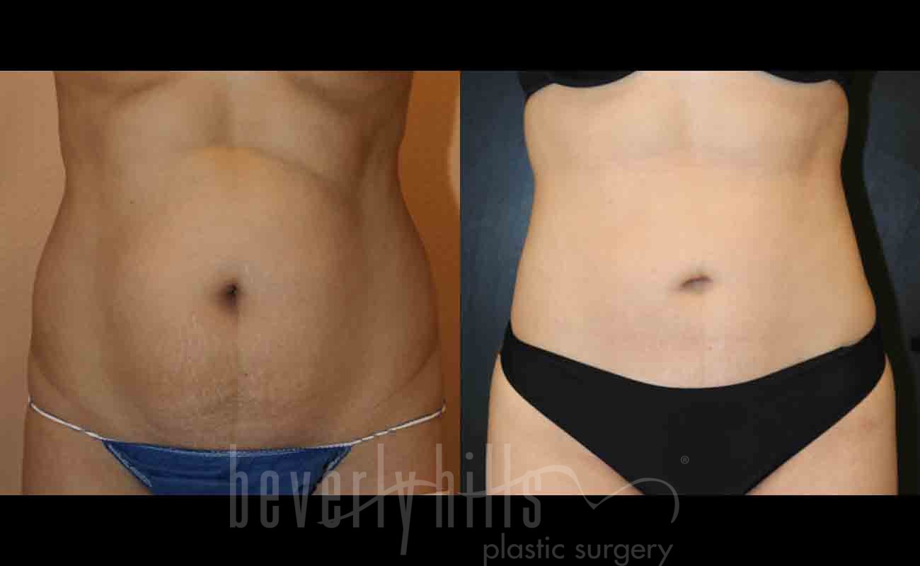 Liposuction Patient 20 Before & After