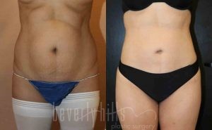 Liposuction Patient 20 Before & After - Thumbnail