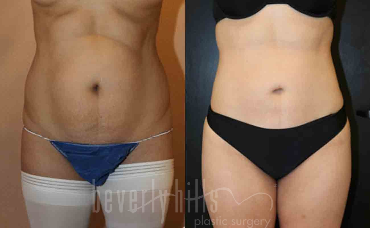 Liposuction Patient 20 Before & After