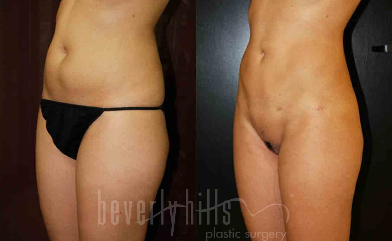 Liposuction Patient 21 Before & After